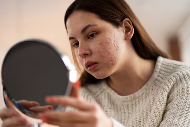 Acne Medicine Recall